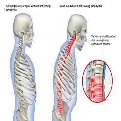Spondylarthrite ankylosante