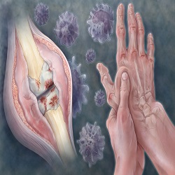 Arthrite Rhumatoïde