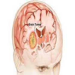Tumeur au Cerveau