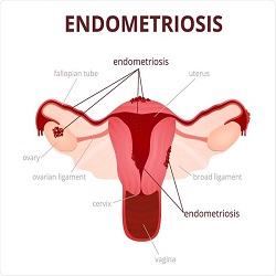 Endométriose