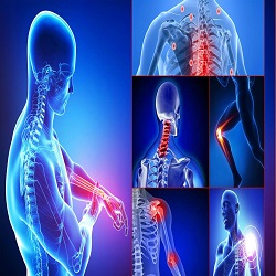 Fibromyalgie