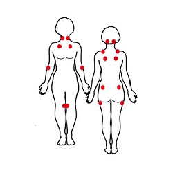 Fibrosite