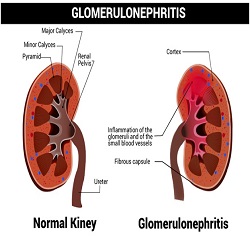 Glomérulonéphrite Traitement
