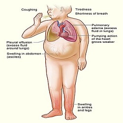 Insuffisance cardiaque