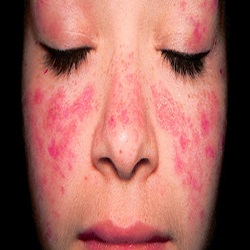 Lupus érythémateux disséminé (Lupus)