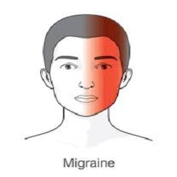 Migraines