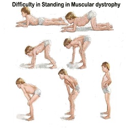 Dystrophie Musculaire