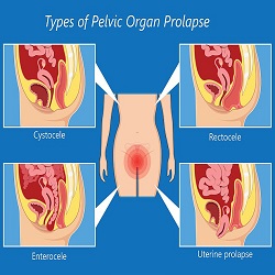 Prolapsus Du Plancher Pelvien