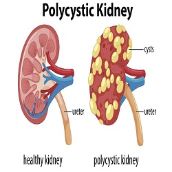 Polykystose Rénale