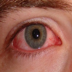 Yeux Rouges