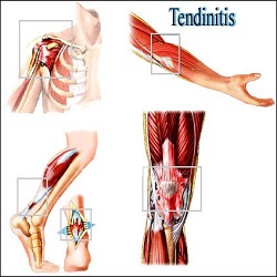 Tendinite