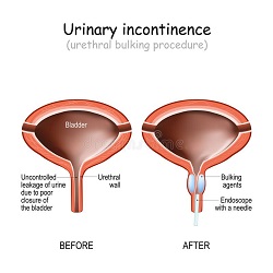 incontinence urinaire