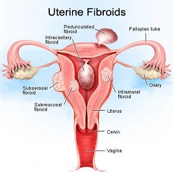 Fibromes Utérins Externes
