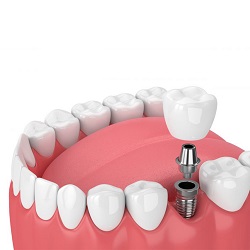 Implants dentaires