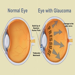Glaucome