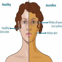 Jaunisse