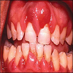 Gonflement Buccal