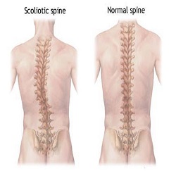 Scoliose