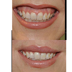 Traitement du sourire gingival